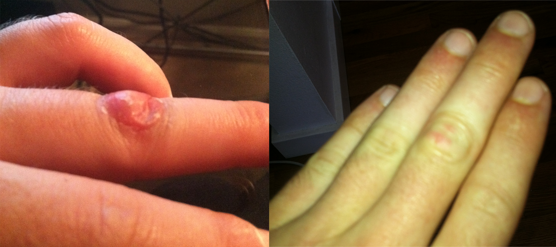 finger wart picture #11